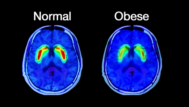 Child obesity and brain function - Mapping Ignorance